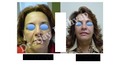 Fat Transfer Fat Grafting Facial Liposculpture